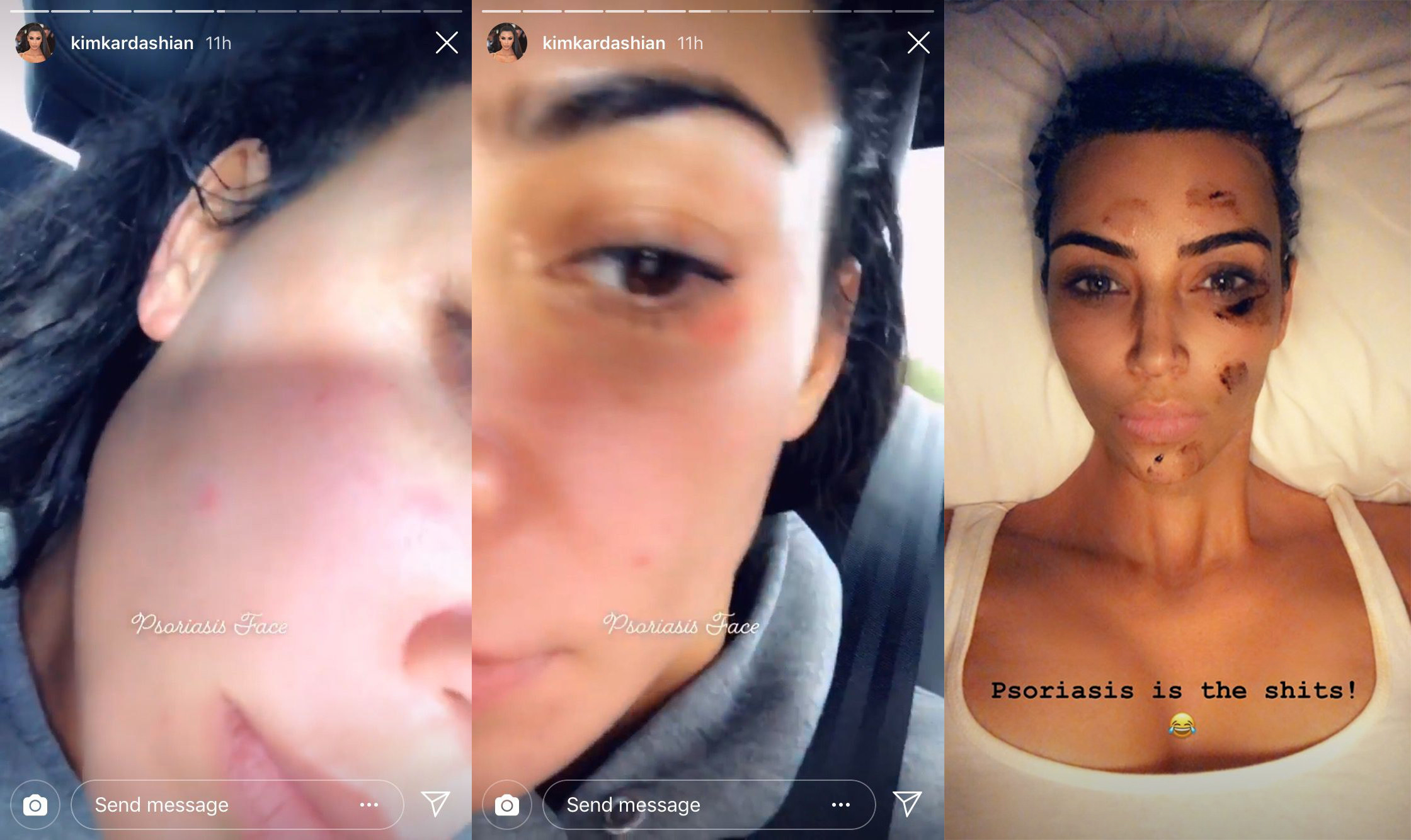 Three images from her IG story showing close-ups of her cheeks and last one with the caption &quot;Psoriasis is the shits!&quot;