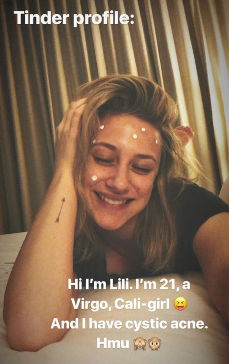 Lili smiling with eyes closed and acne medication dotting her face, with the headline &quot;Tinder profile&quot; and the caption, &quot;Hi I&#x27;m Lili, I&#x27;m 21, a Virgo, Cali-girl And I have cystic acne Hmu&quot;