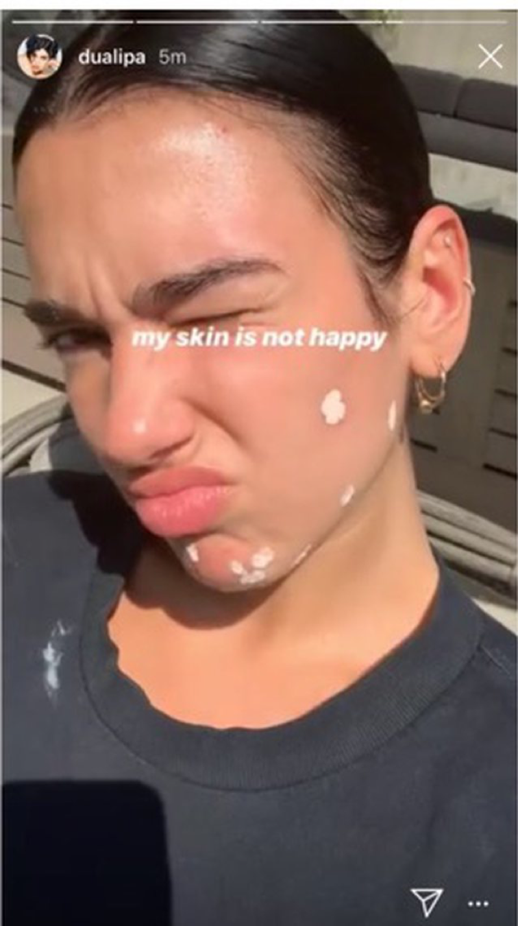 A screenshot from her IG story with medication dotted on her face with the caption, &quot;My skin is not happy&quot;