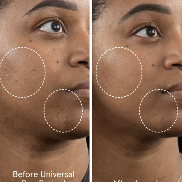 before and after images of model using retinol