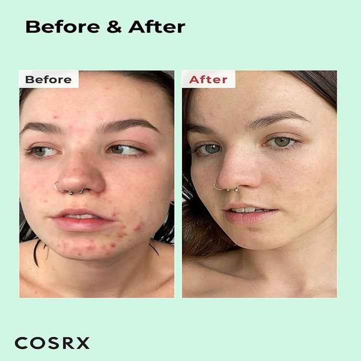 Before-and-after results of using COSRX BHA liquid