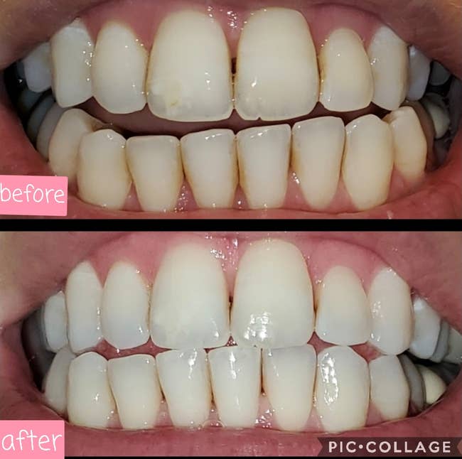 a split of a reviewer's teeth before and after using the whitening pen with them much whiter and brighter after
