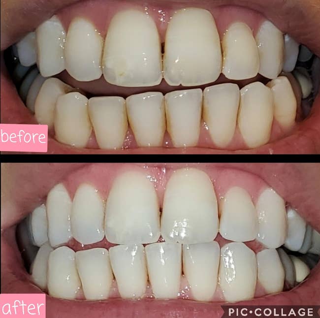 a split of a reviewer's teeth before and after using the whitening pen with them much whiter and brighter after