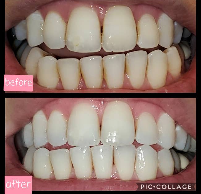 a split image of a reviewer's teeth before and after using the whitening pen