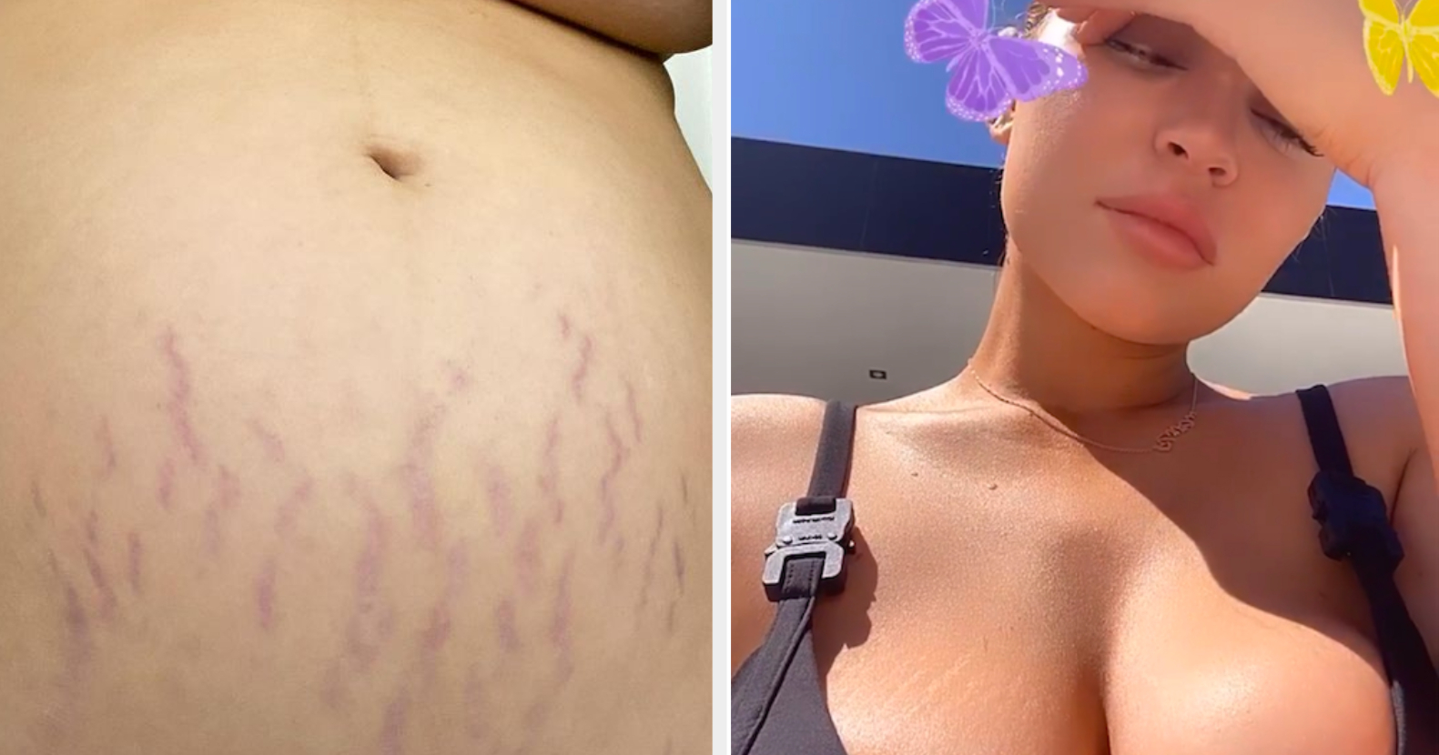 Celebs with stretch marks at as a teenager