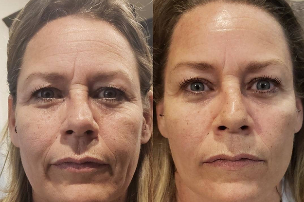 L: side by side of a reviewer before and after using a skin-tightening mask and you can clearly tell that the mask reduced the appearance of wrinkles on their forehead and around their eyes