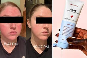 a before and after of a reviewer showing their skin is no longer red; someone squeezing cleanser into their hand