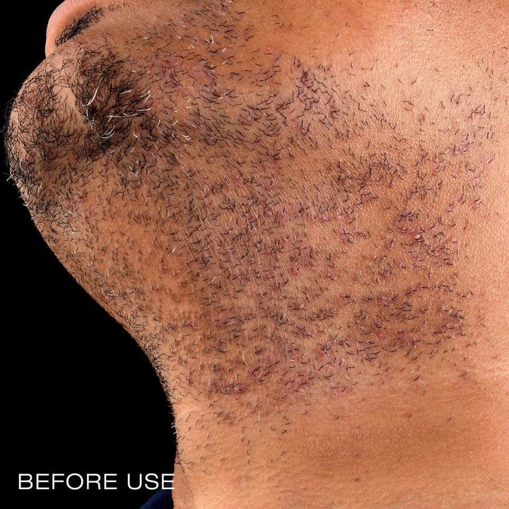 before image of a model with razor bumps under chin