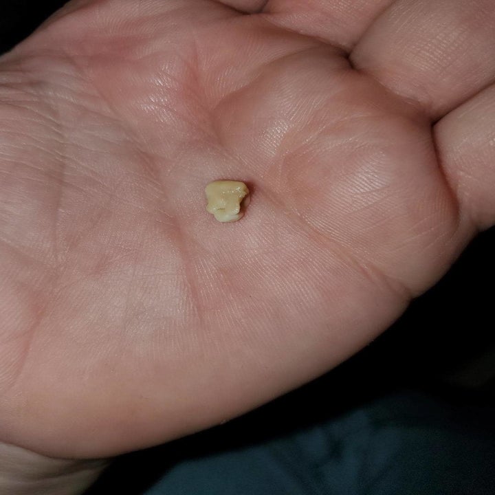 Reviewer holding a tonsil stone they removed using the kit