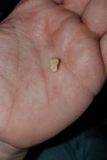 Reviewer holding a tonsil stone they removed using the kit