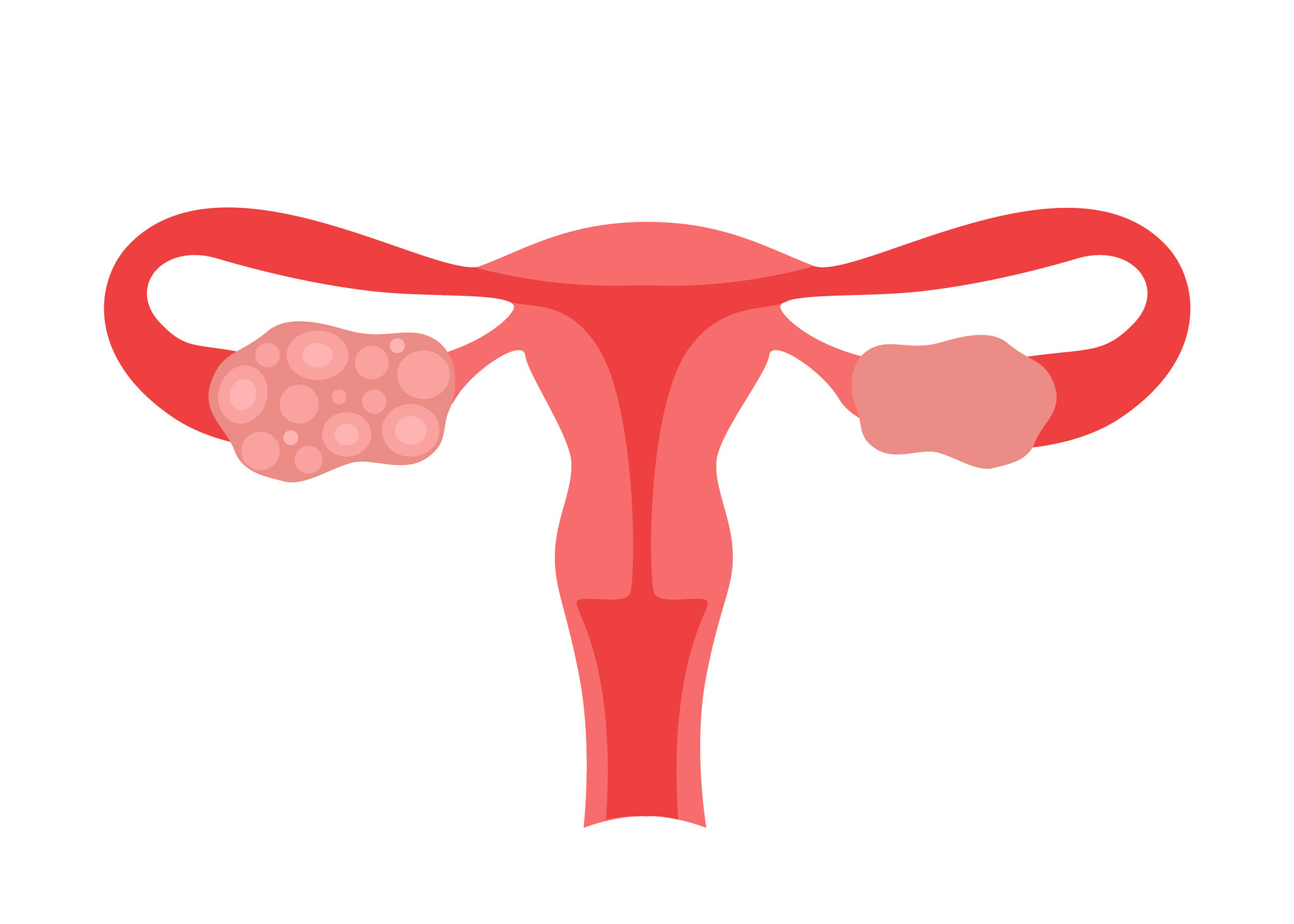drawing of uterus with PCOS