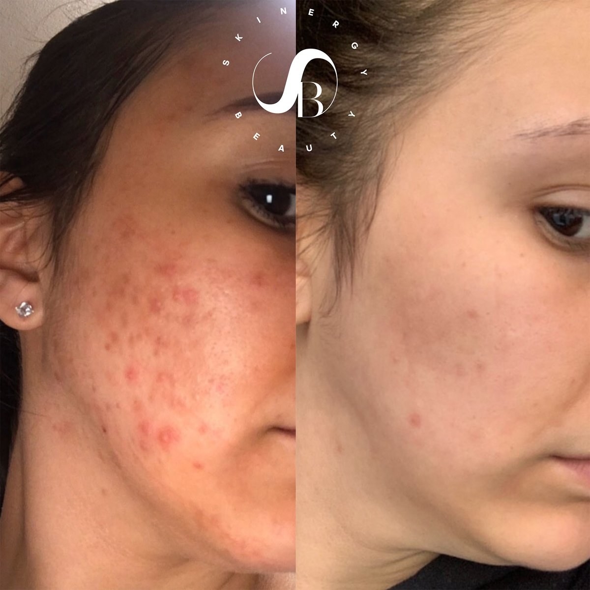 before and after images of a model whose acne disappears