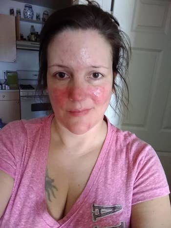 reviewer with rosacea flare up on face