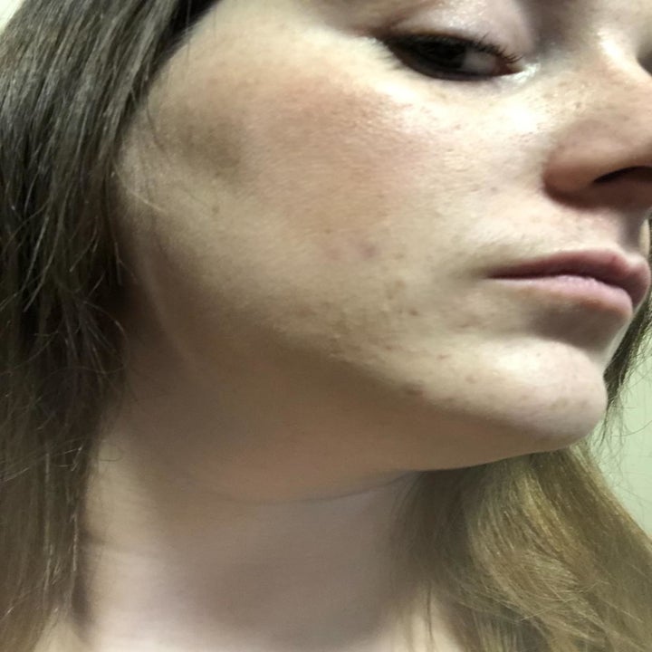 An "after" image with the redness completely gone and the acne nearly disappeared
