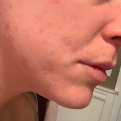 Same reviewer's cheeks, which are now a more even skin tone and free of almost all breakouts