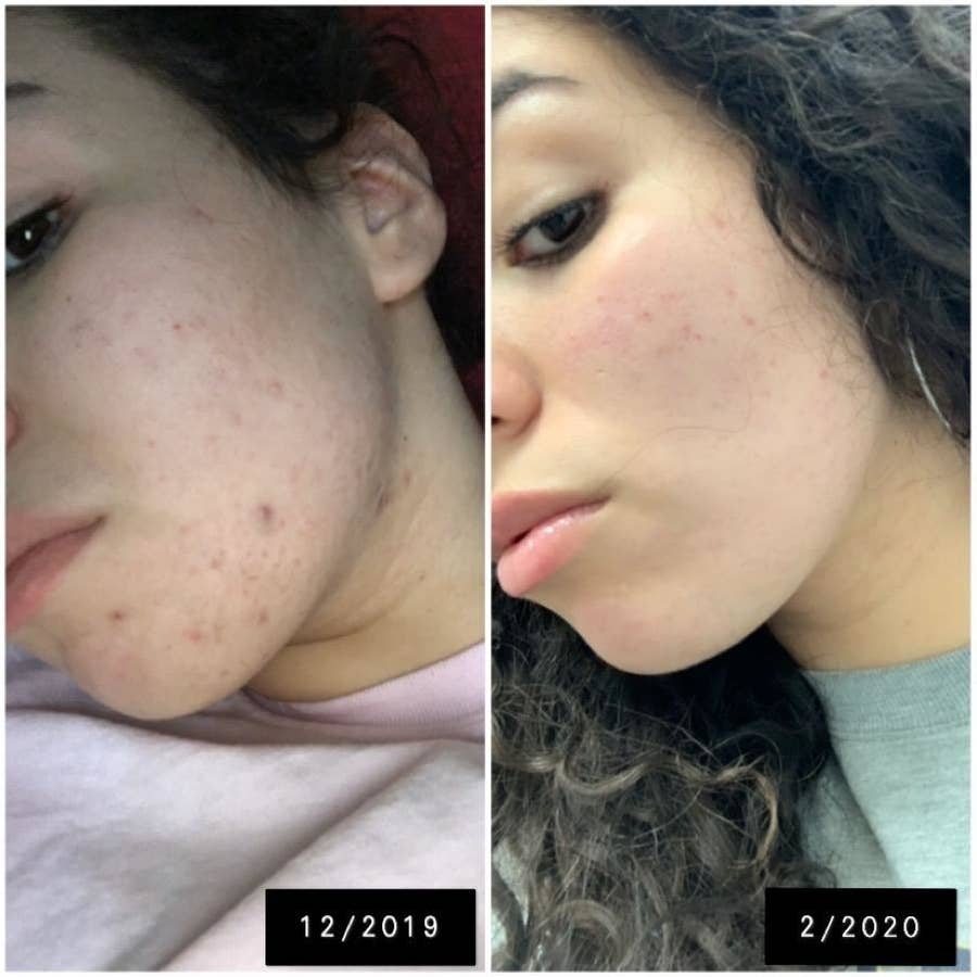 31 Skincare Products With Before & After Photos So Dramatic, We Made Them  Click To Reveal