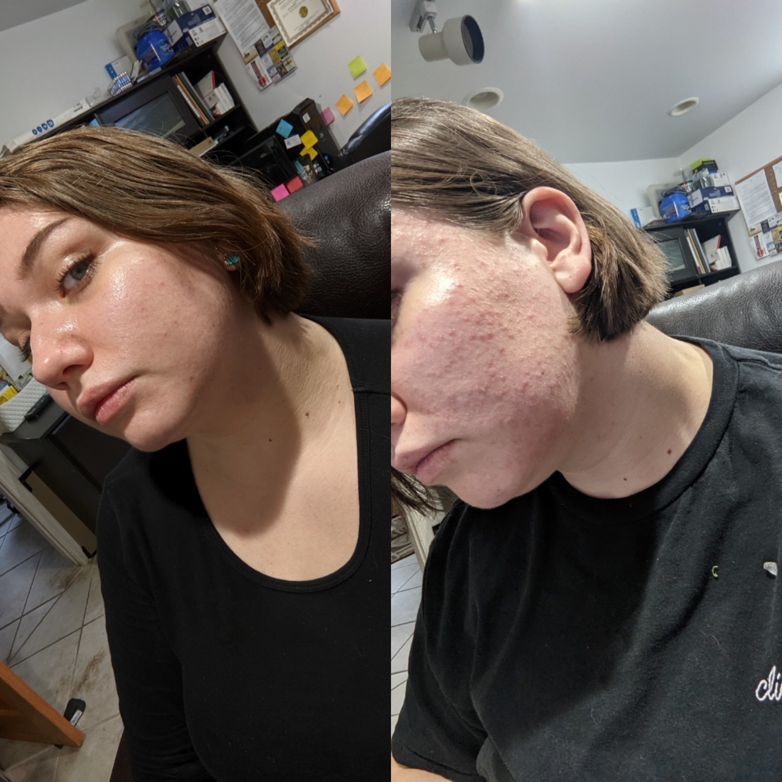 A reviewer showing reduced skin texture and acne