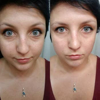 Before-and-after picture showing dark circles/bags on left and less puffiness on right after using same gold under-eye masks