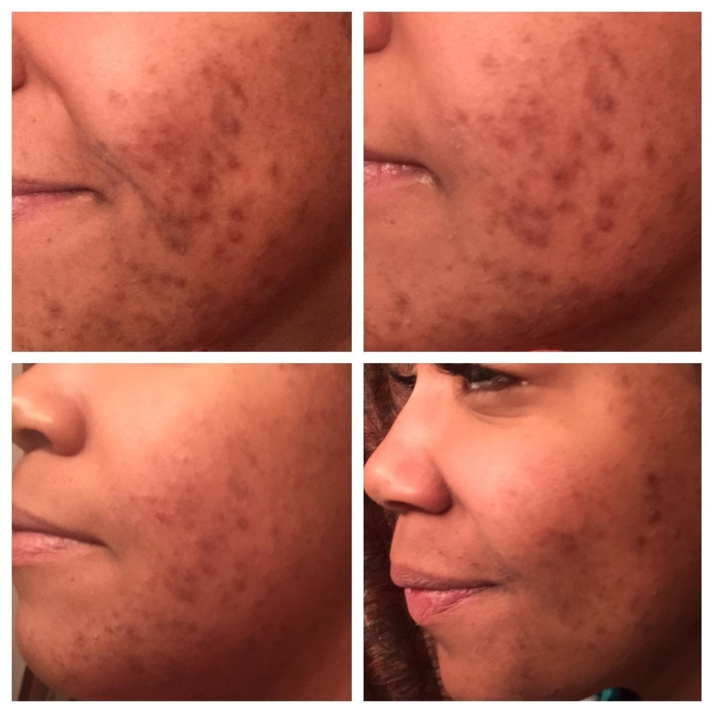 four images showing acne and scarring fading on a reviewer&#x27;s cheek