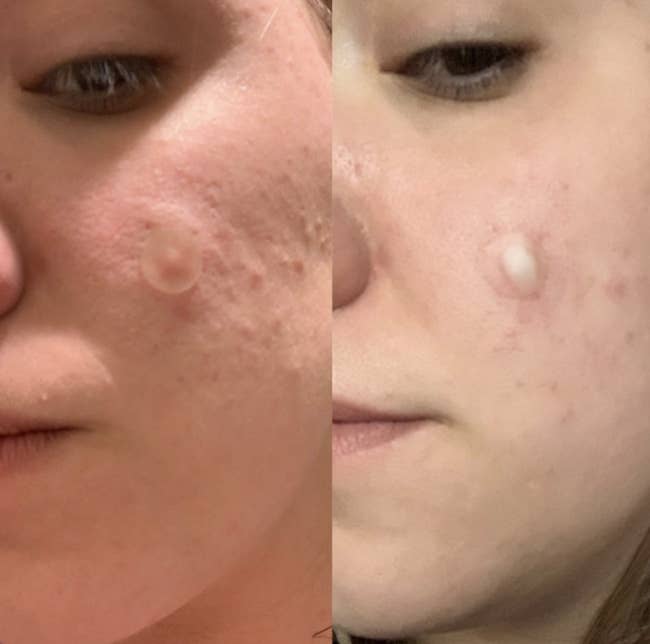 before and after of a review using the patch on a pimple on their cheek