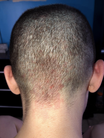 reviewer with buzz cut hair with irritated skin seen through it