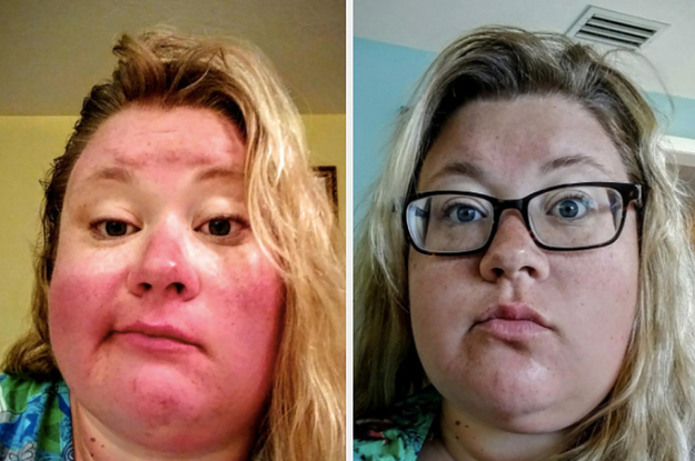 reviewer pic showing a very bad sunburn on the face then the same reviewer with makeup on and looking a bit tan rather than severely sunburned