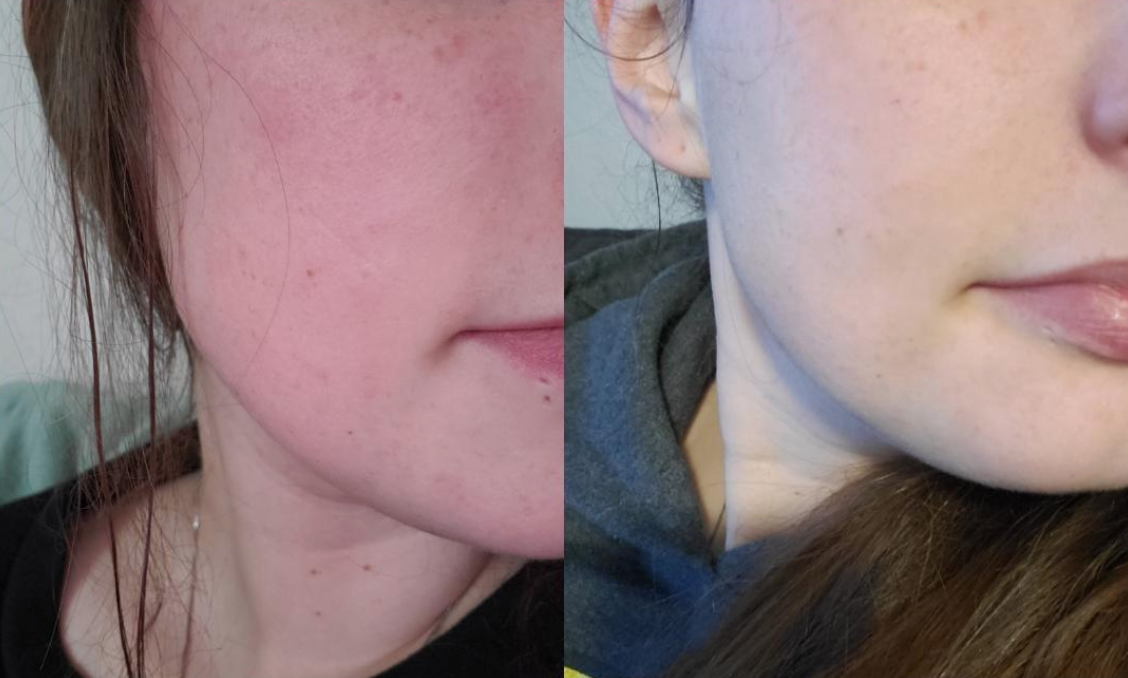 A reviewer&#x27;s red, skin before applying the cream ; A reviewer&#x27;s less irritated skin after applying the cream.