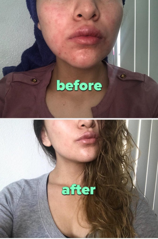 a before and after of a reviewer&#x27;s skin