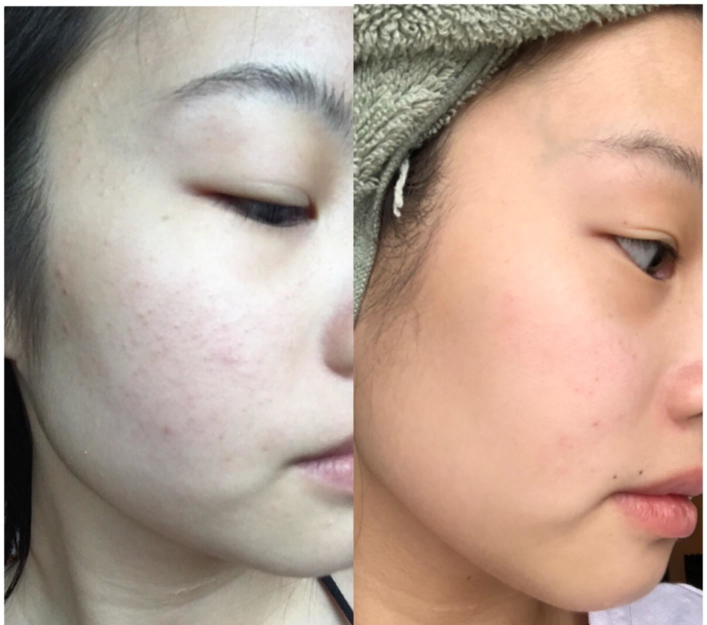 a before and after of a reviewer that has red bumps in the before but not in the after photo