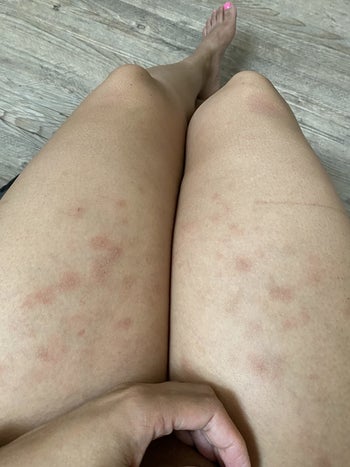 a before photo of thighs with noticeable rash and irritated skin