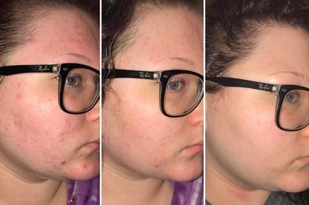 reviewer pic of cheek with painful looking breakouts, then with the same cheek healing up, then the same cheek completely clear
