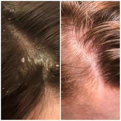 reviewer with super flaky then clear scalp