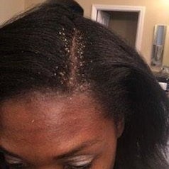 A reviewer's head with lots of dandruff flakes around their part