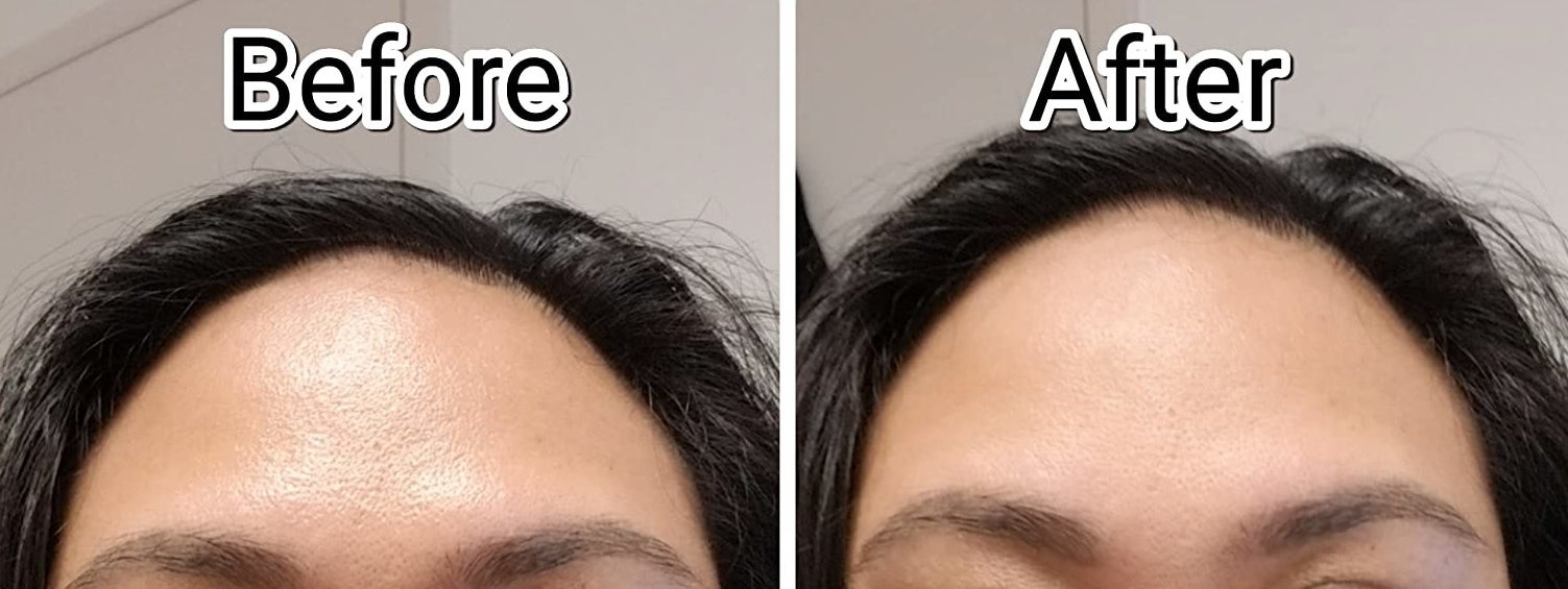 reviewer&#x27;s oily forehead before using the face roller compared to it looking much more matte after using it