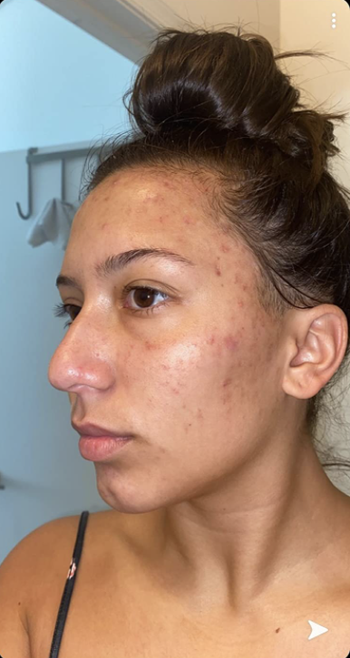 reviewer with acne breakouts on cheek and forehead