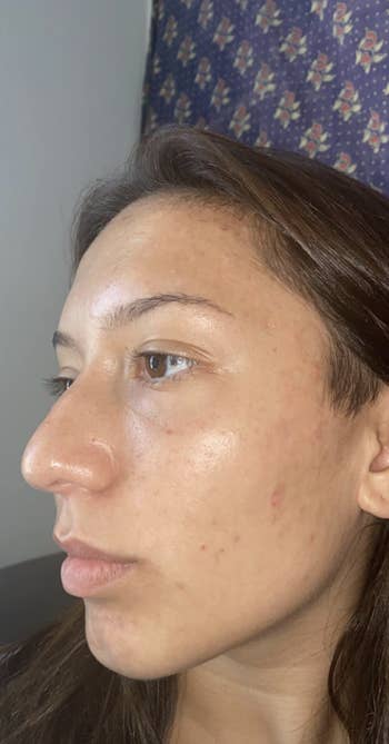 same reviewer with healing and lightened breakouts