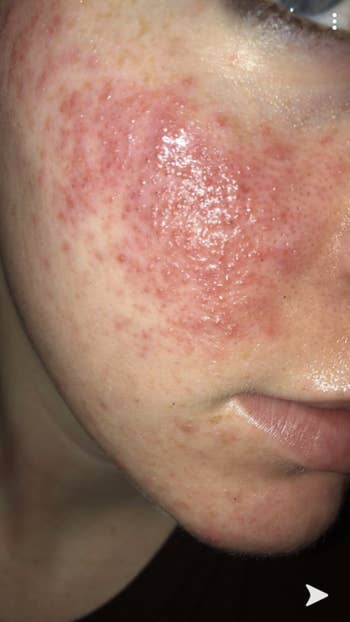 reviewer with painful looking inflamed rosacea breakout on cheek