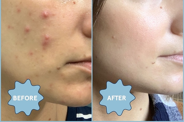 before and after pic of person with pimple and then clear skin