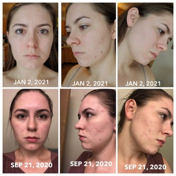 bottom right to top left: series of before-and-after photos showing reviewer's acne-covered face on Sept. 21 and a much-clearer face on Jan. 2 after using the treatment for a few months