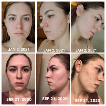 bottom right to top left: series of before-and-after photos showing reviewer's acne-covered face on Sept. 21 and a much-clearer face on Jan. 2 after using the treatment for a few months