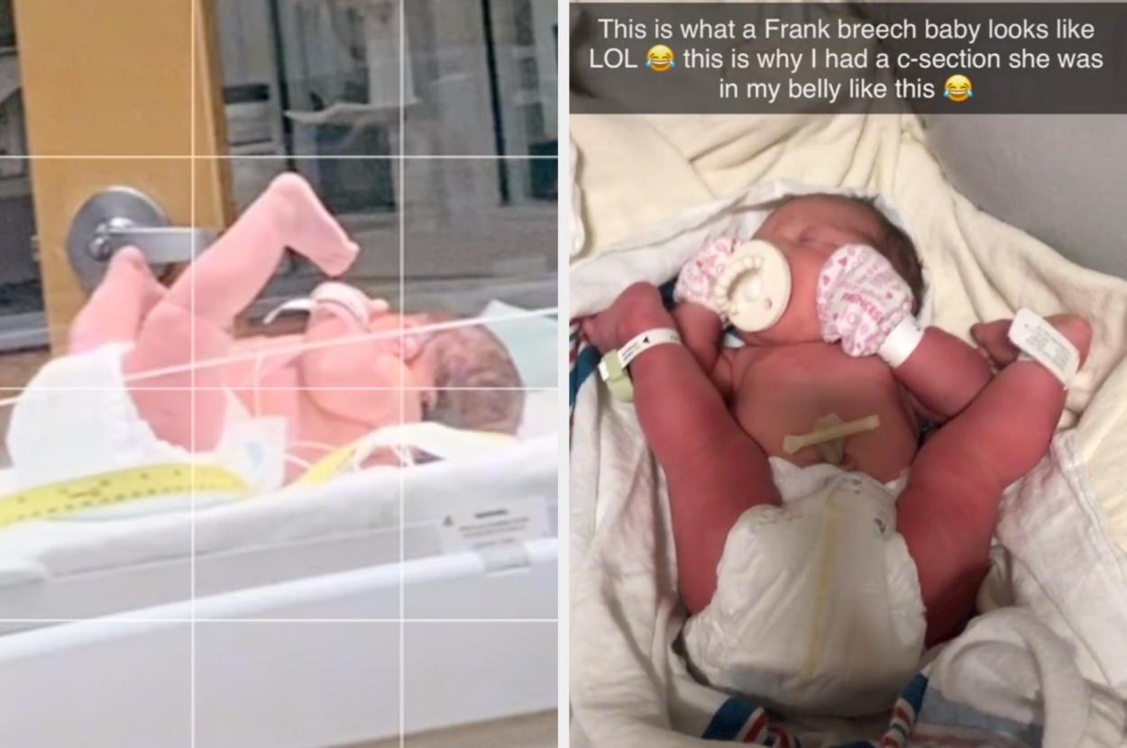 Frank Breech Baby Viral TikTok Explainer