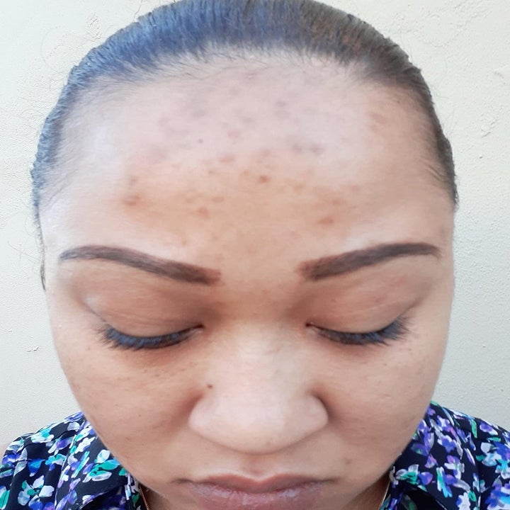 before photo of a reviewer's acne-scarred forehead