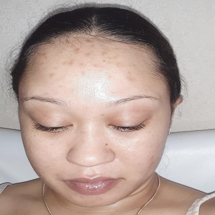 the same reviewer after using the serum and their dark forehead scars have lightened a lot