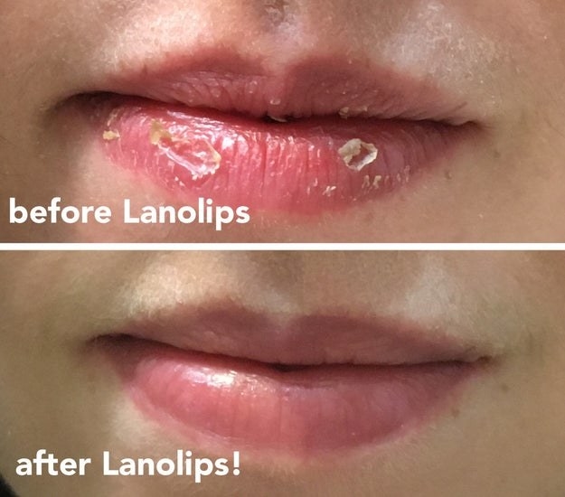 Natalie showing before and after of chapped lips before using the treatment and after with smooth lips