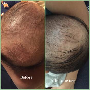 another reviewer's before photo showing cradle cap on their baby's head and after photo showing the cradle cap cleared up
