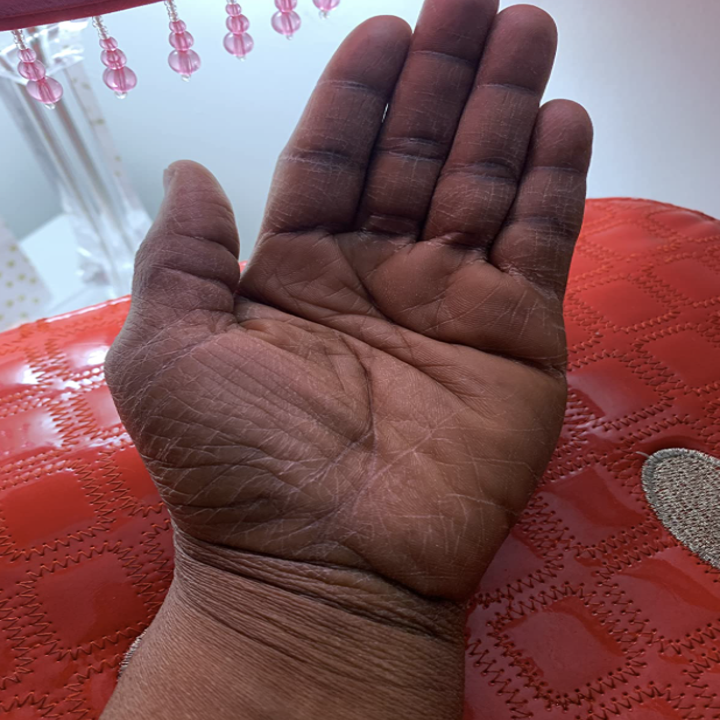 reviewer with dry, cracked hand 