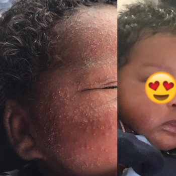 Reviewer's before photo showing eczema on their baby's face and after photo showing the eczema cleared up