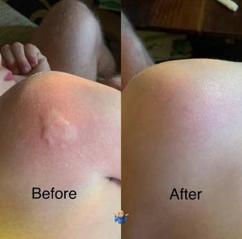 reviewer before and after images; in the before image a big mosquito bite bulges from the skin and in the after image, the bite is gone