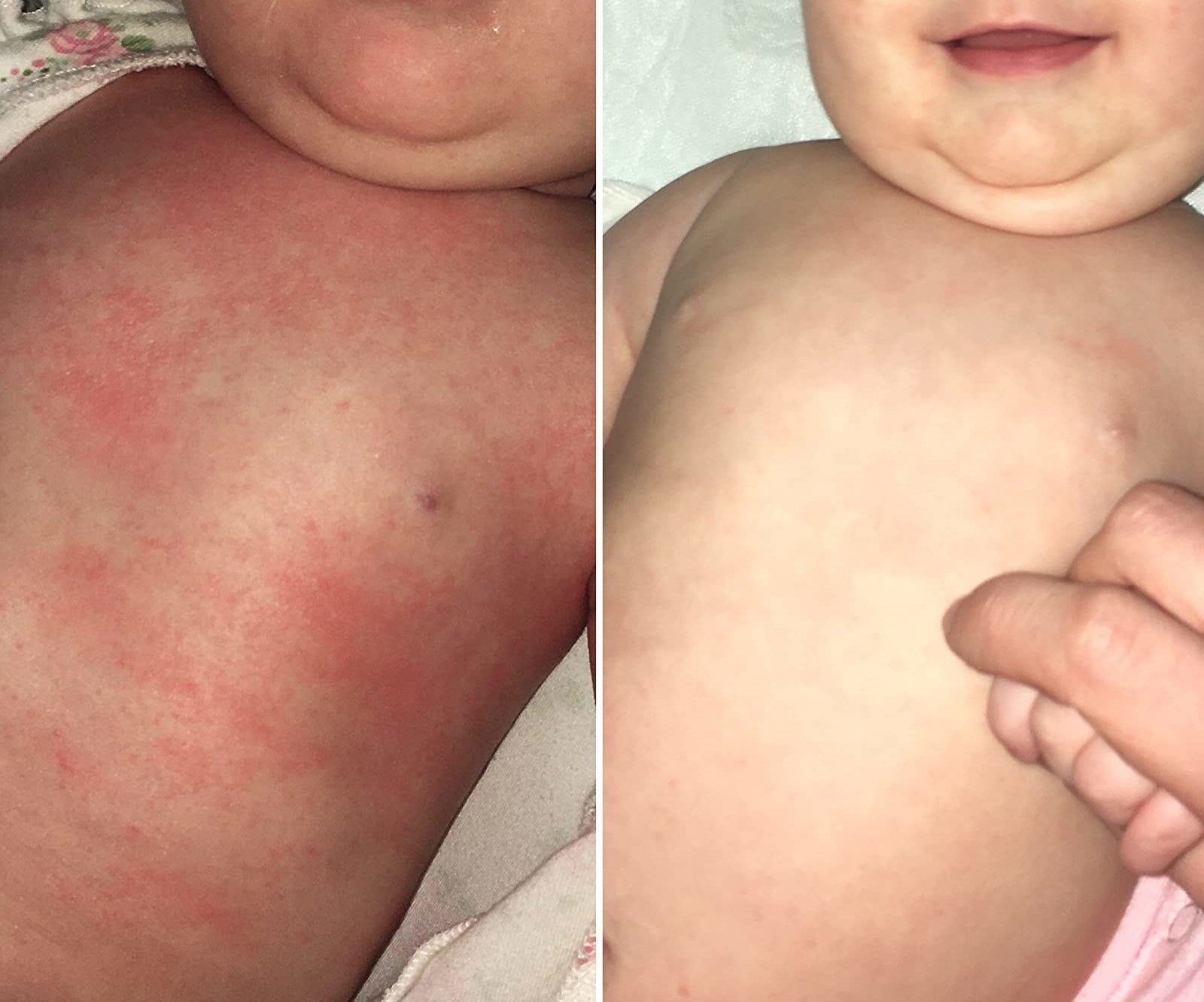 Reviewer&#x27;s before photo showing their baby&#x27;s tummy covered with eczema rashes and after photo showing the tummy with the eczema rashes gone