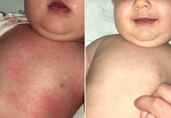 Reviewer's before photo showing their baby's tummy covered with eczema rashes and after photo showing the tummy with the eczema rashes gone
